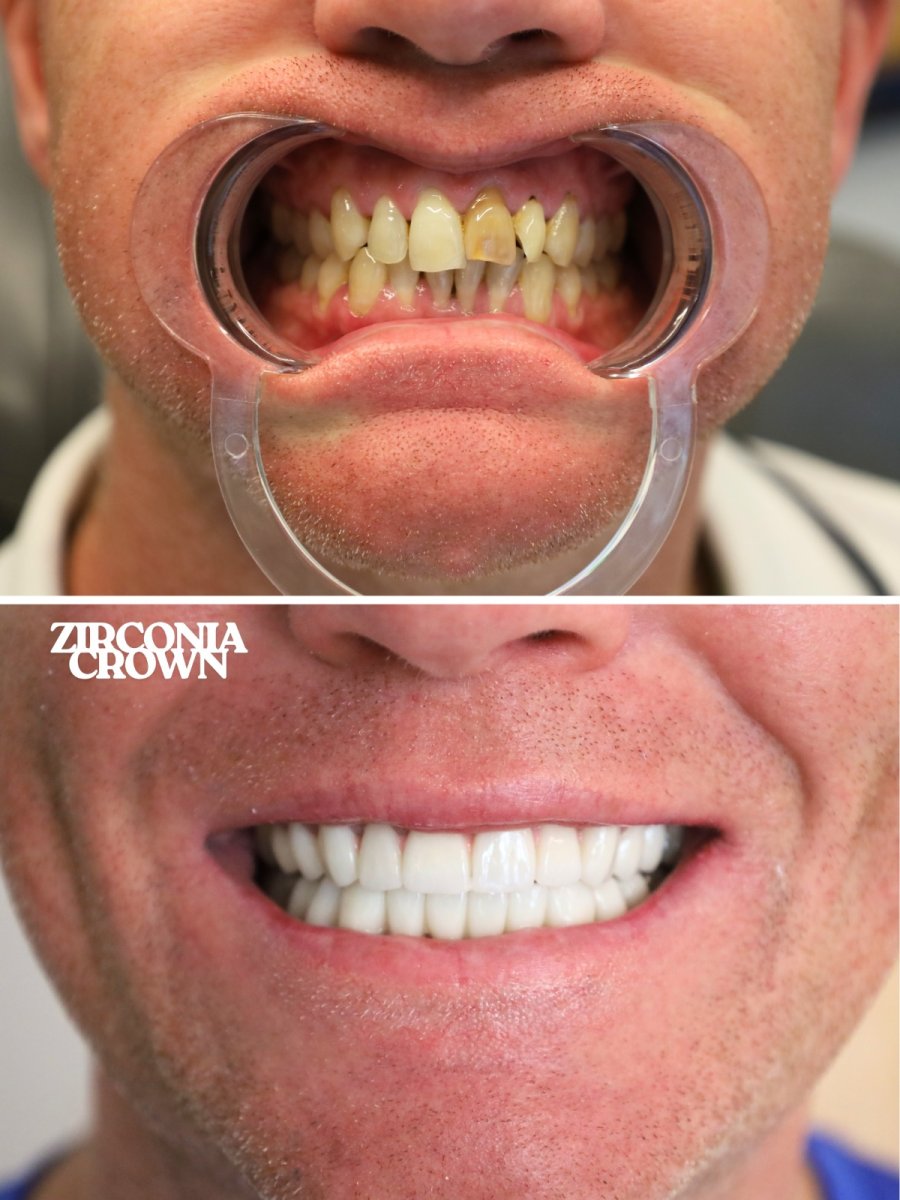 Efekty przed i po założeniu koron cyrkonowych w WestDent Clinic – naturalny uśmiech