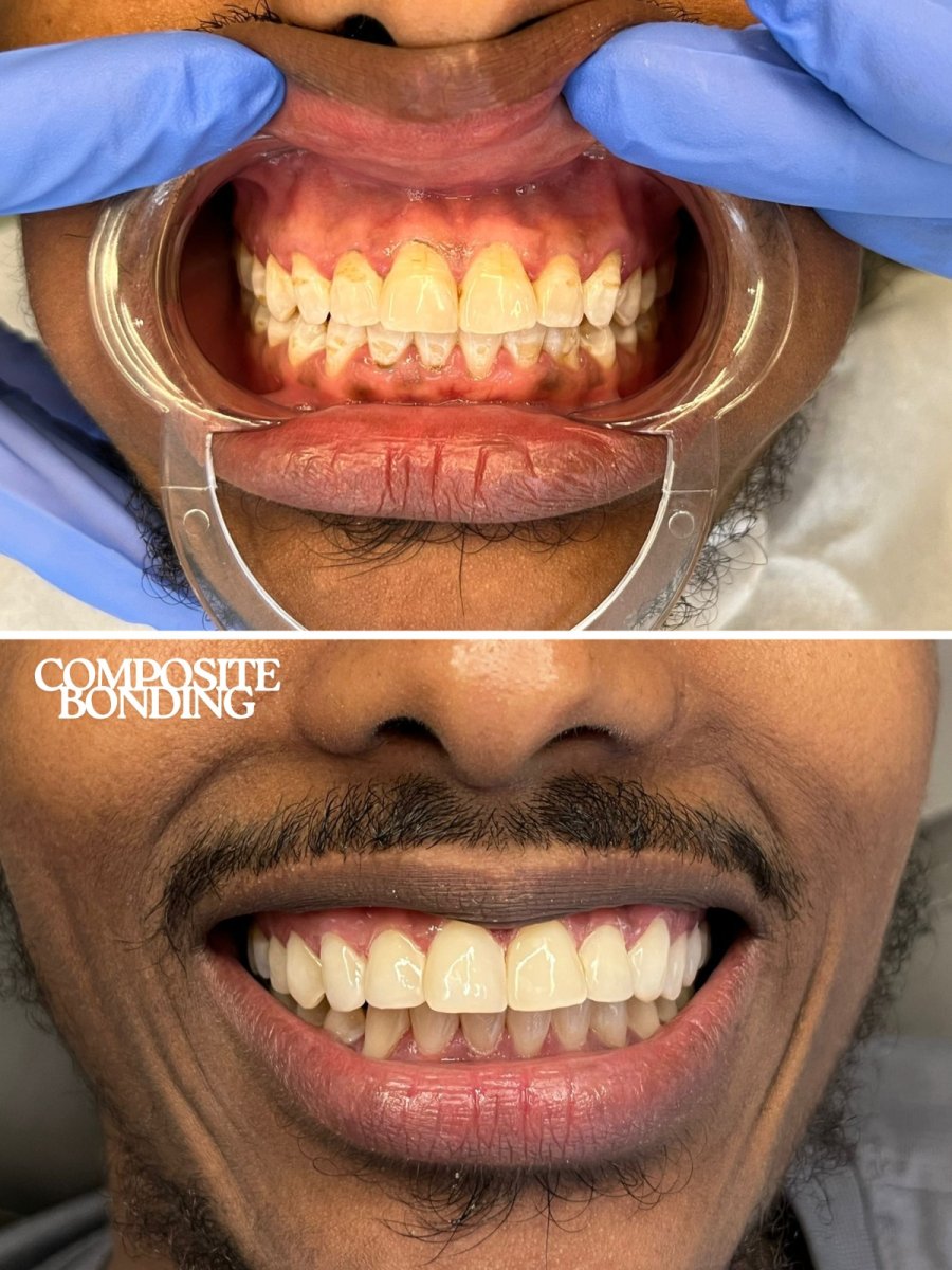 Before and after composite veneer results at WestDent Clinic, improved smile aesthetics