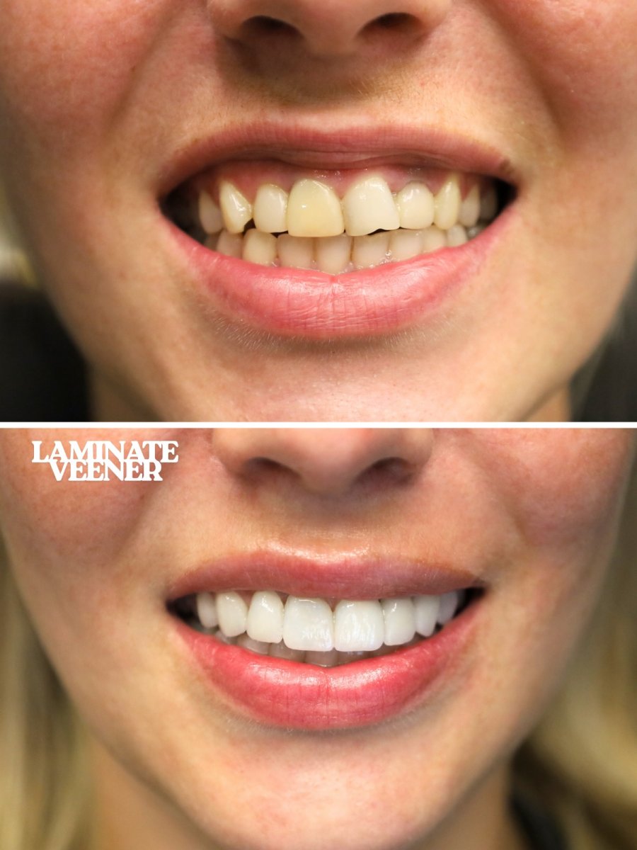 До и после установки виниров в WestDent Clinic – преображение улыбки, результат виниров