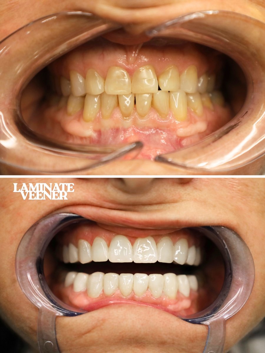 Before and after laminate veneer results at WestDent Clinic – improved smile aesthetics
