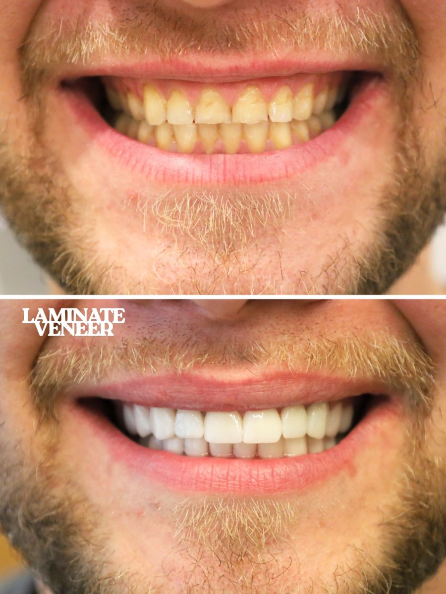 Before and after results of dental veneers at WestDent Clinic, improved smile aesthetics