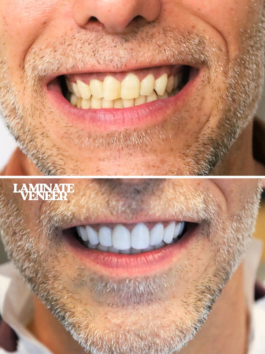 نتائج قبل وبعد فينير الأسنان في WestDent Clinic – ابتسامة طبيعية ومحسنة