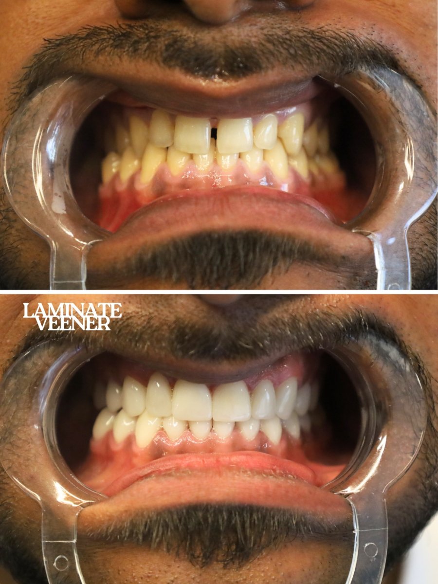 Before and after laminate veneer results at WestDent Clinic – smile makeover with veneers
