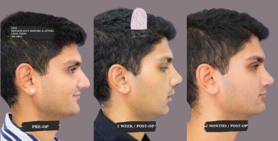 Rhinoplasty& Septoplasty All Included Package with Top Surgeon