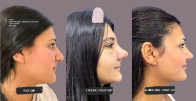 Rhinoplasty& Septoplasty All Included Package with Top Surgeon - photo 2