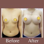 صور قبل وبعد تكبير الثدي للدكتور Dr Phatcharasak Kraisornphongsakul Md