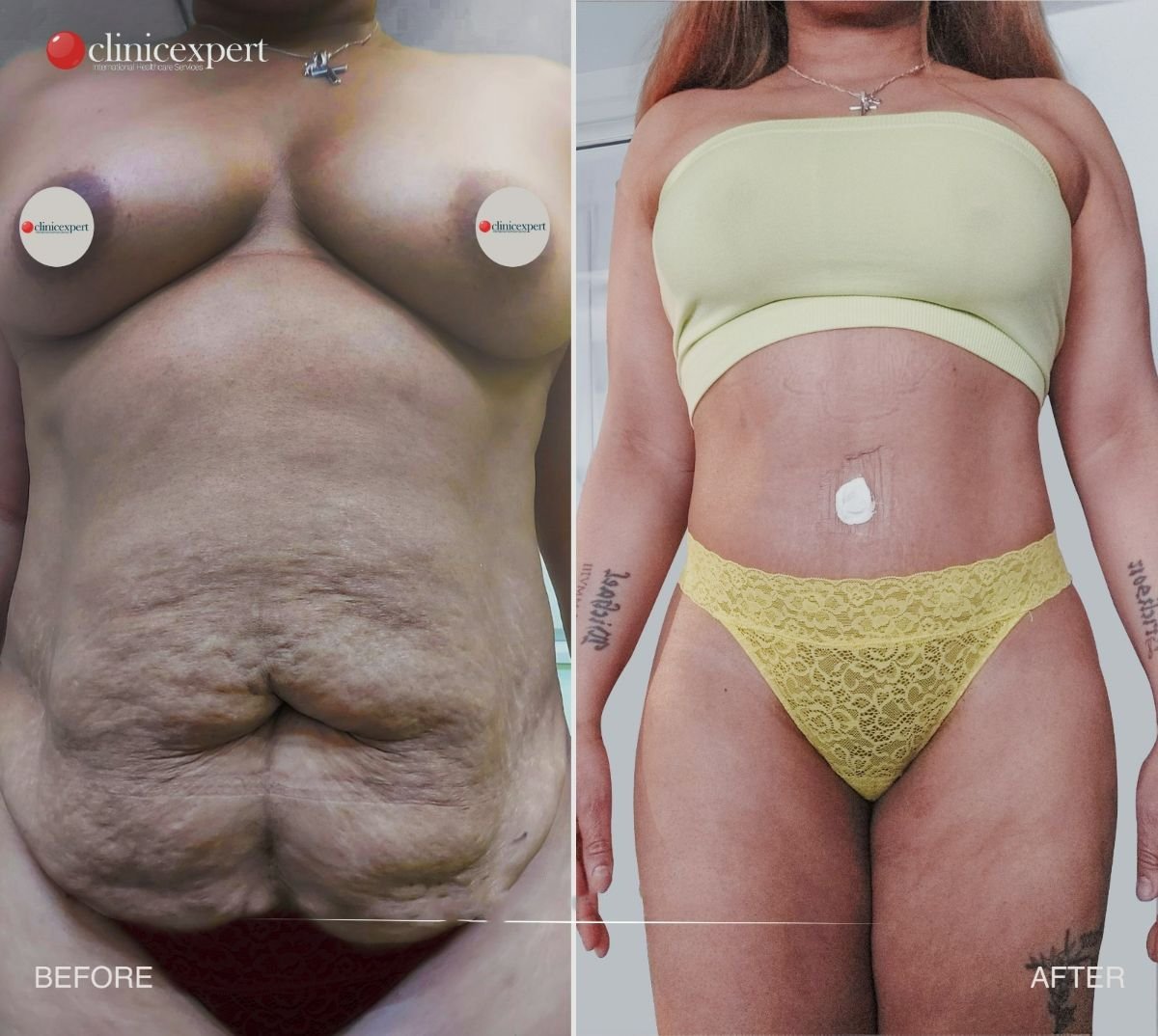 Before and after abdominal liposuction results at CE International Hospital, improved body contour