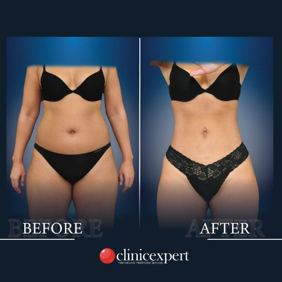 Before and after abdominal liposuction results at CE International Hospital, slimmer waistline
