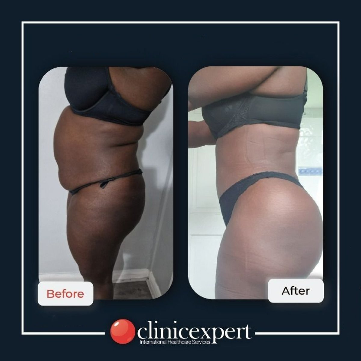 Before and after Brazilian Butt Lift results at CE International Hospital, enhanced body contour