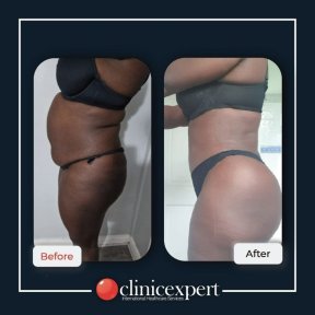 Premium Brazilian Butt Lift with All Included