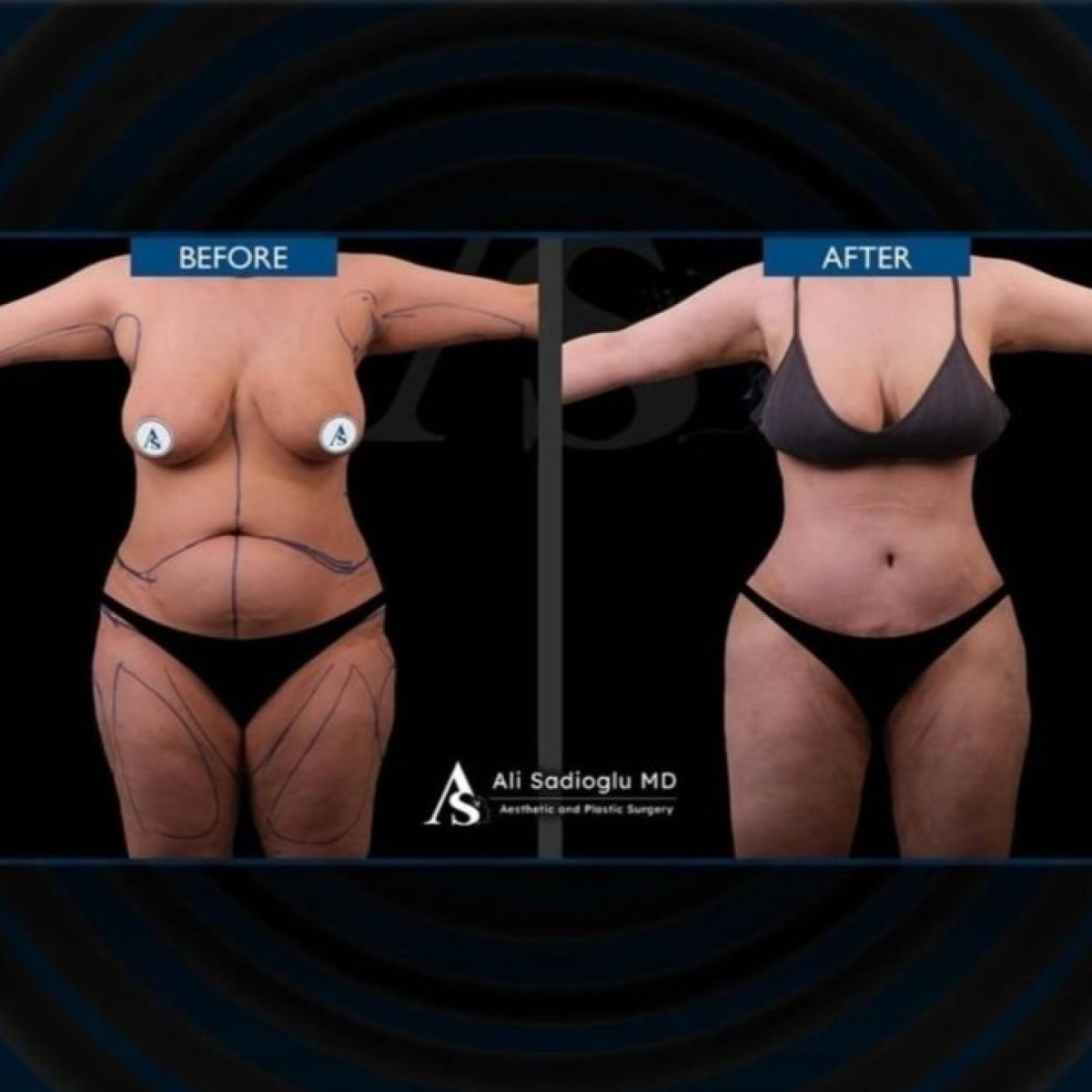 Full body lift before and after results at Dr. Safa Manav Clinic, visible body contouring