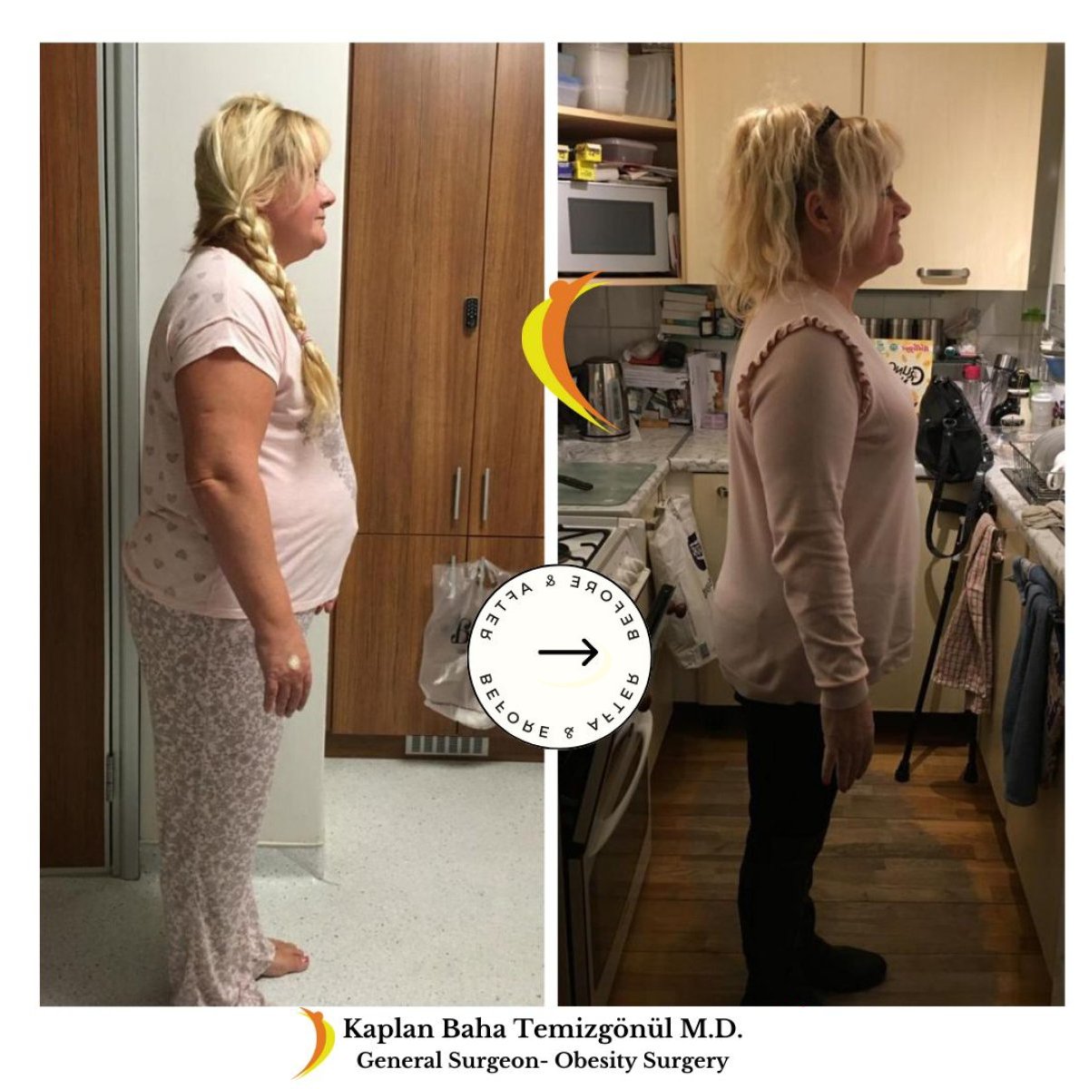 نتائج قبل وبعد جراحة تحويل مسار المعدة في Lotus Bariatrics Clinic – فقدان وزن واضح