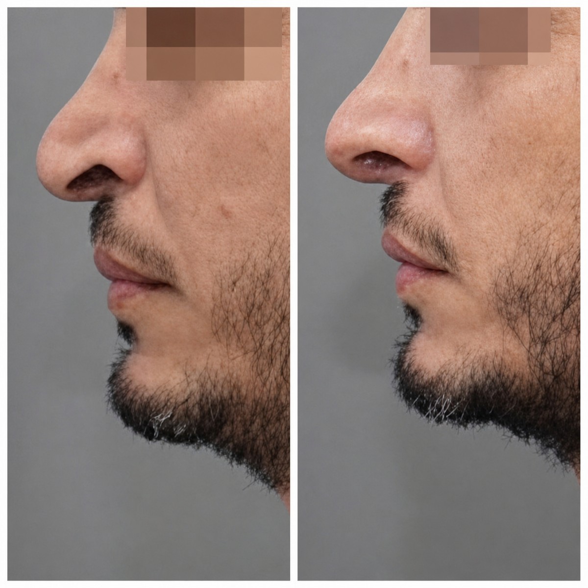 Résultats avant et après rhinoplastie à Assuta Medical Center, profil du nez amélioré