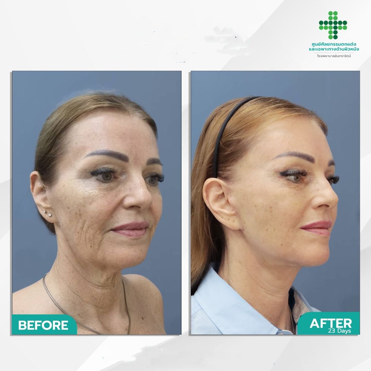 Facelift before and after results at Intrarat Hospital – visible facial rejuvenation and lift