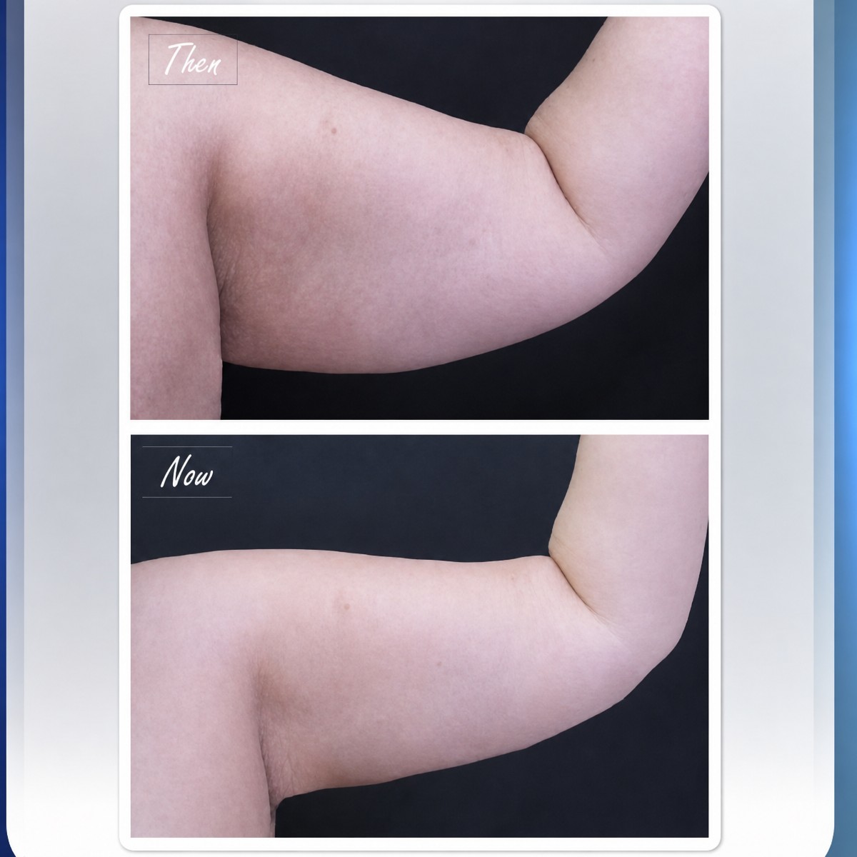 Before and after arm lift results at Asia Cosmetic Hospital, improved arm contour after brachioplasty