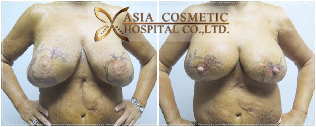 Результаты до и после уменьшения сосков в Asia Cosmetic Hospital, улучшение формы груди