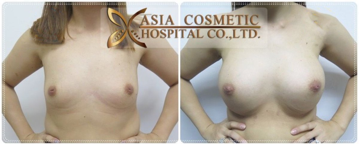 Before and after breast augmentation results at Asia Cosmetic Hospital, enhanced breast shape