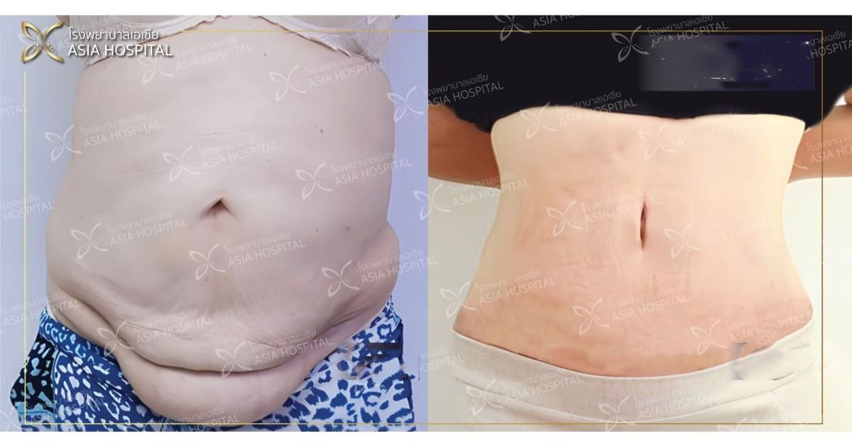 Before and after mommy makeover results at Asia Cosmetic Hospital, improved abdominal contour