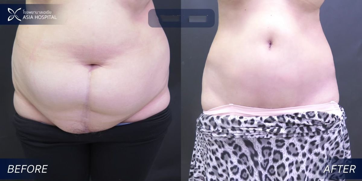 Mommy makeover before and after results at Asia Cosmetic Hospital – visible abdominal contouring