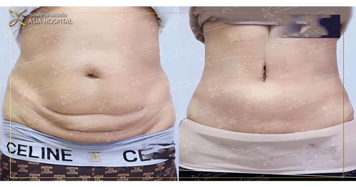 Mommy makeover before and after results at Asia Cosmetic Hospital – flatter, firmer abdomen