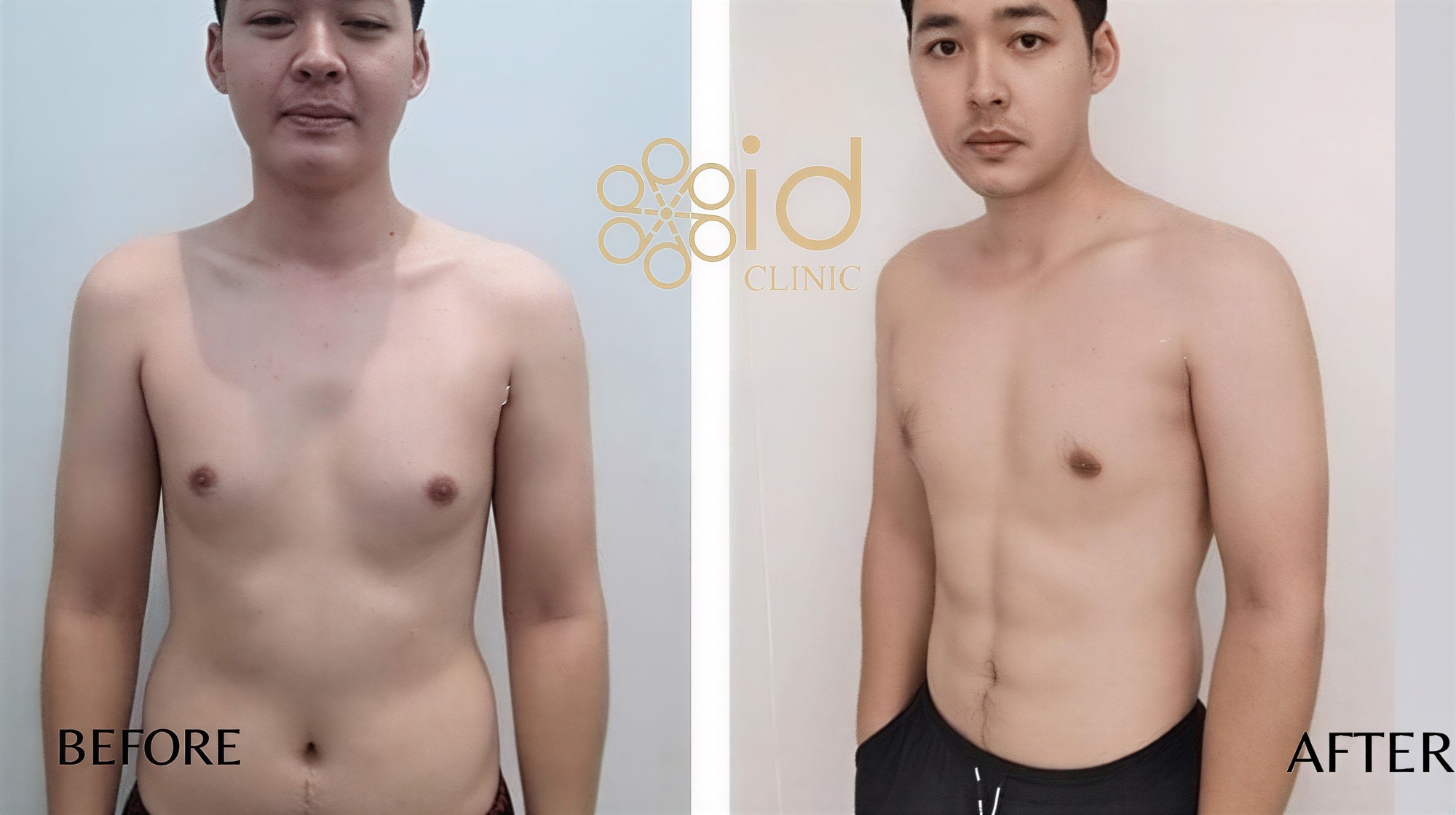 Resultados antes y después de Vaser liposucción en ID Clinic Bangkok, mejor contorno corporal