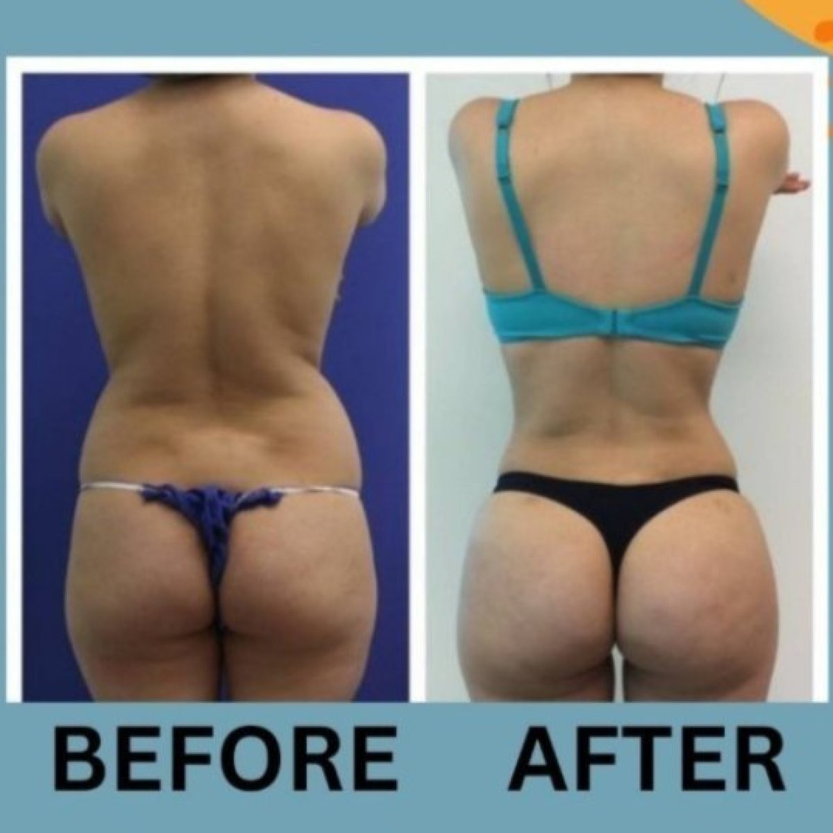 Before and after buttock lift results at ID Clinic Bangkok, improved contour and firmness