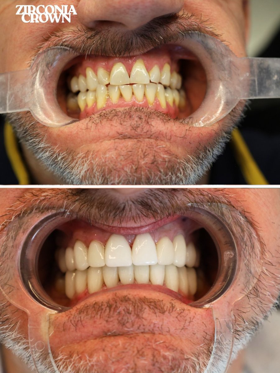 Before and after zirconia crown results at WestDent Clinic – improved smile aesthetics