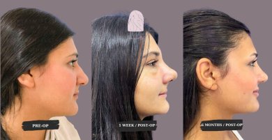 Rhinoplasty& Septoplasty All Included Package with Top Surgeon - photo 2