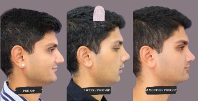 Rhinoplasty& Septoplasty All Included Package with Top Surgeon