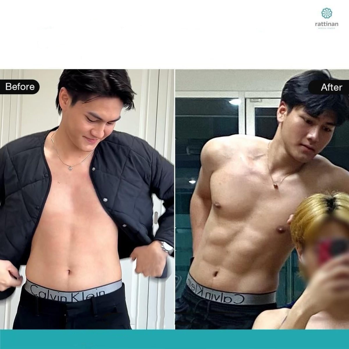 Antes y después de liposucción de flancos en Rattinan Clinic, resultado visible de contorno corporal