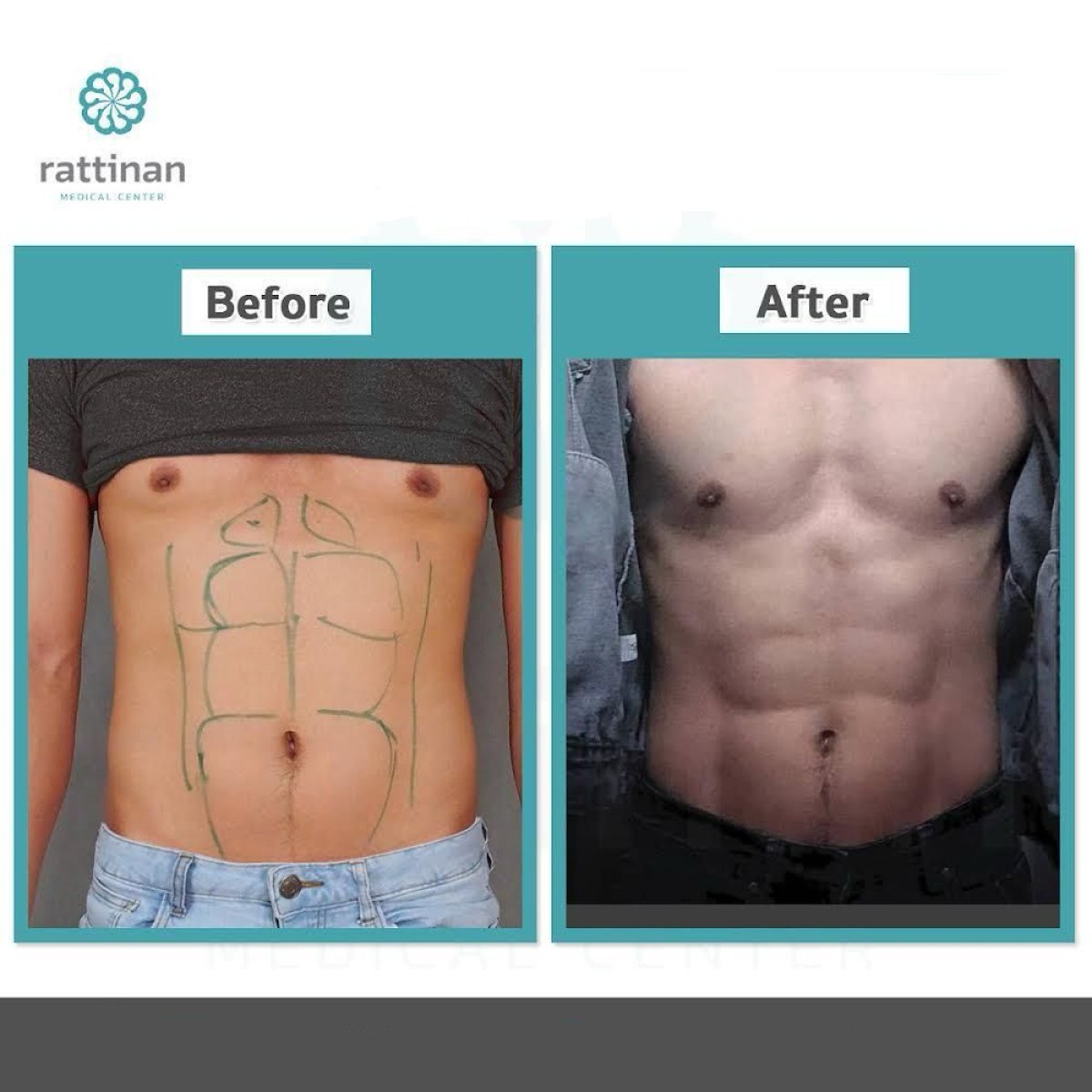 Antes y después de liposucción de flancos en Rattinan Clinic, resultado visible del abdomen