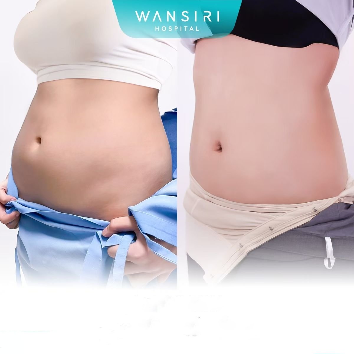 Before and after Vaser liposuction results at Wansiri Hospital, abdomen contour improvement