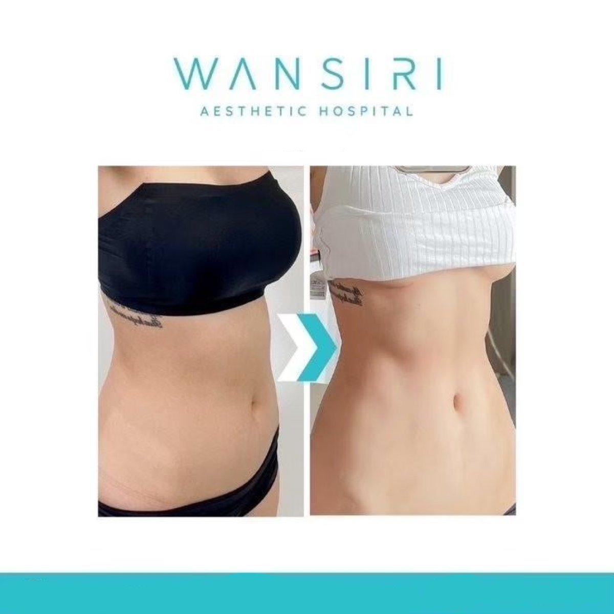 Résultats avant/après liposuccion Vaser à Wansiri Hospital, amélioration du contour de taille