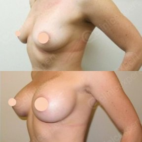 Premium Breast lift with Motiva® Ergonomix® breast implants All Inclusive - photo 6