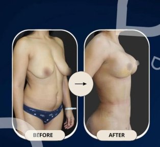 Premium Tummy Tuck All Inclusive - photo 3