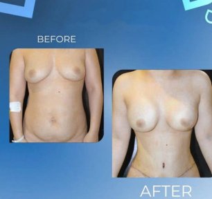 Premium Tummy Tuck All Inclusive - photo 4