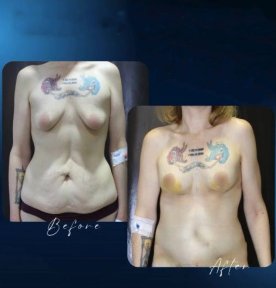 Premium Tummy Tuck All Inclusive - photo 6