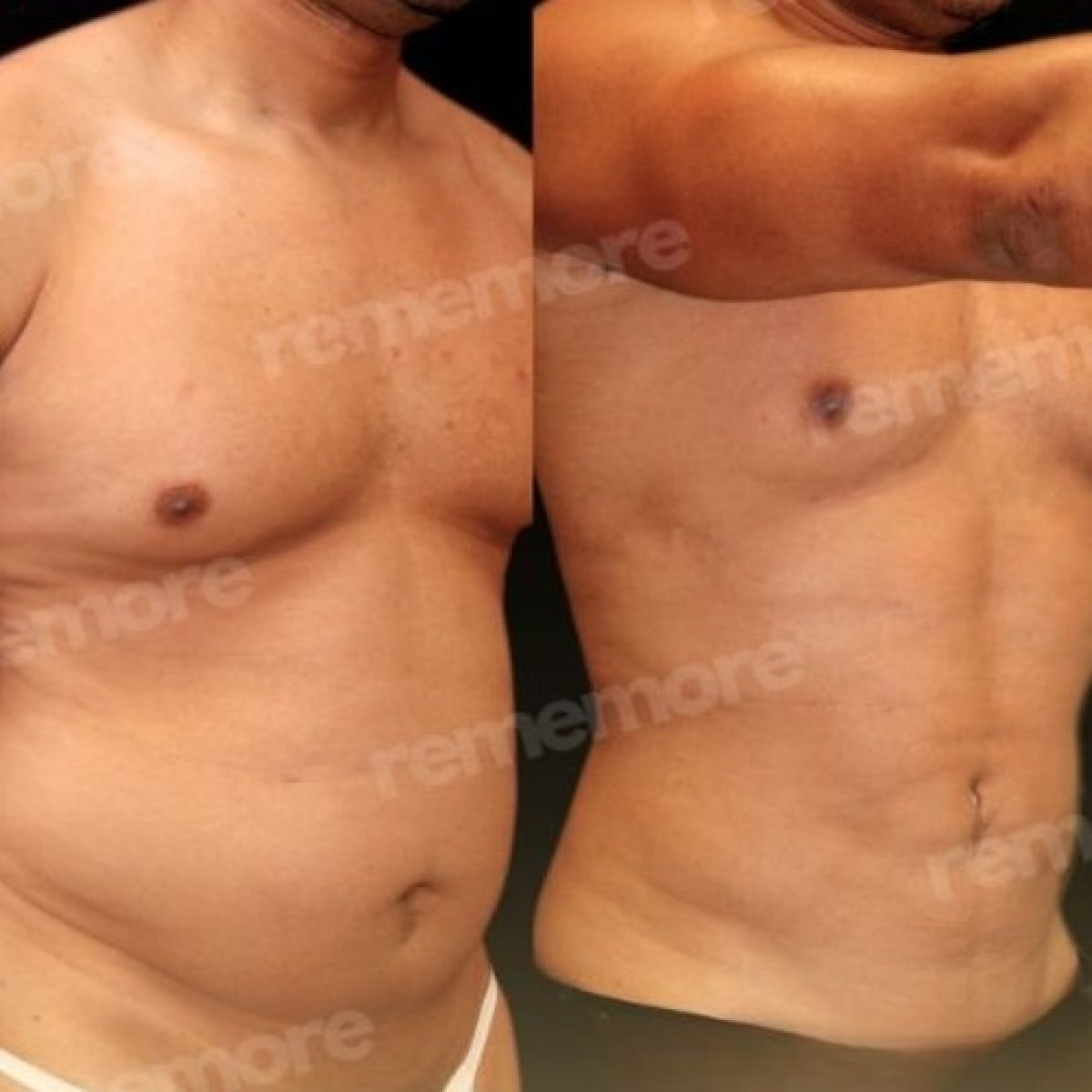 Resultados antes y después de marcación abdominal en Memorial Bahçelievler Hospital, abdominales definidos