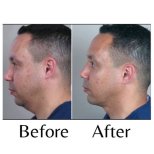 Ergebnisse der Vaser-Fettabsaugung durch Dr. Dr Phatcharasak Kraisornphongsakul Md — Vorher- und Nachher-Fotos des Patienten Fotos vor und nach Vaser-Fettabsaugung durch Dr. Dr Phatcharasak Kraisornphongsakul Md