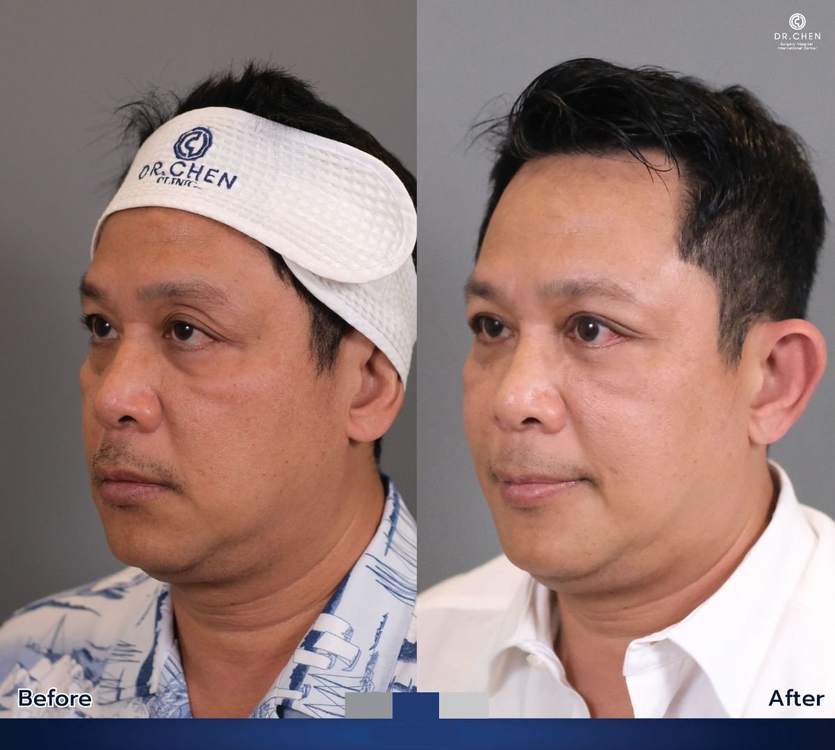 نتائج رأب الجفن قبل وبعد في Dr. Chen Surgery Hospital International Center