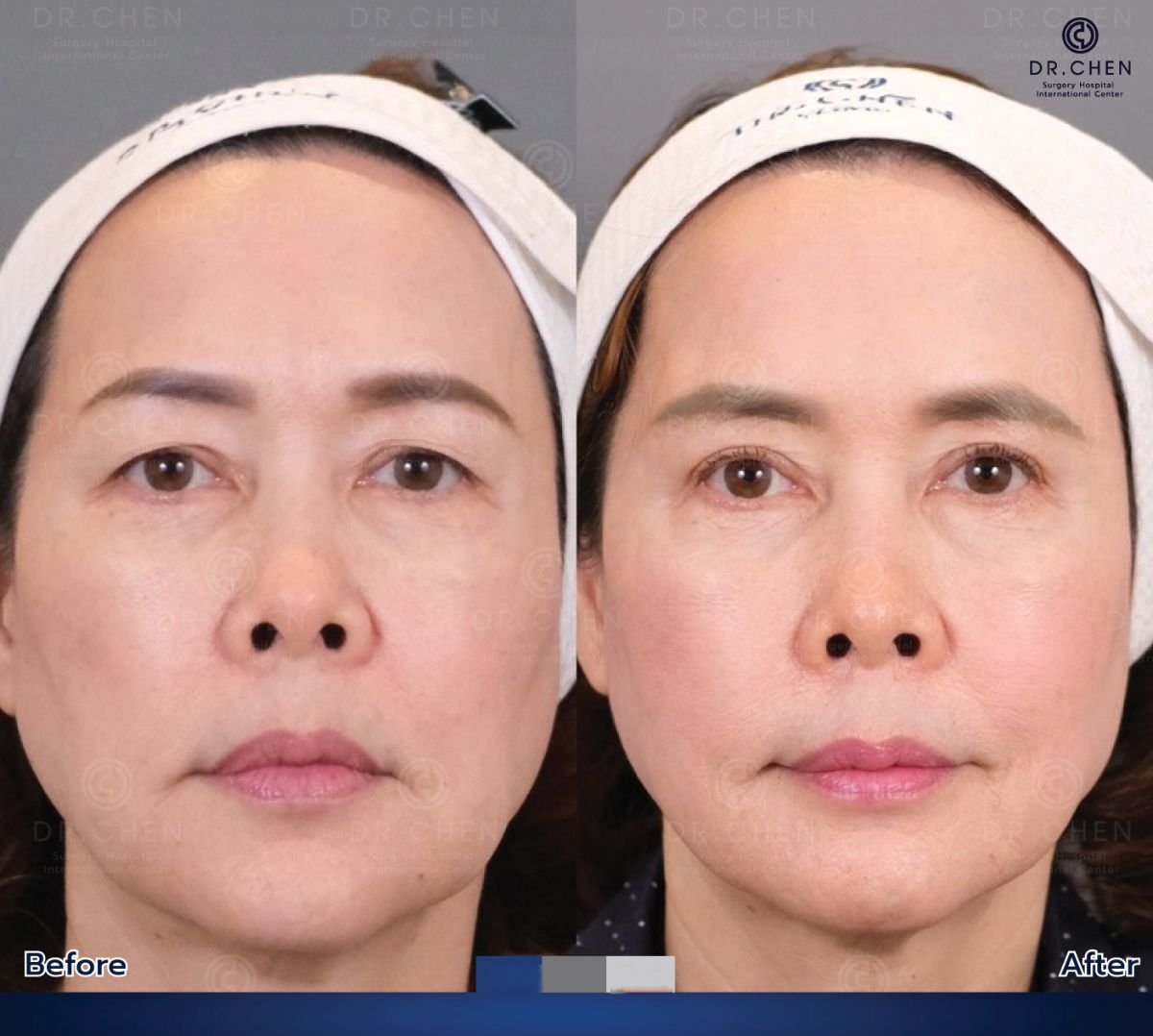 Résultats avant et après blépharoplastie au Dr. Chen Surgery Hospital International Center