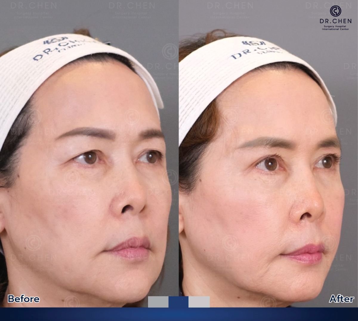 Résultats avant et après blépharoplastie au Dr. Chen Surgery Hospital International Center