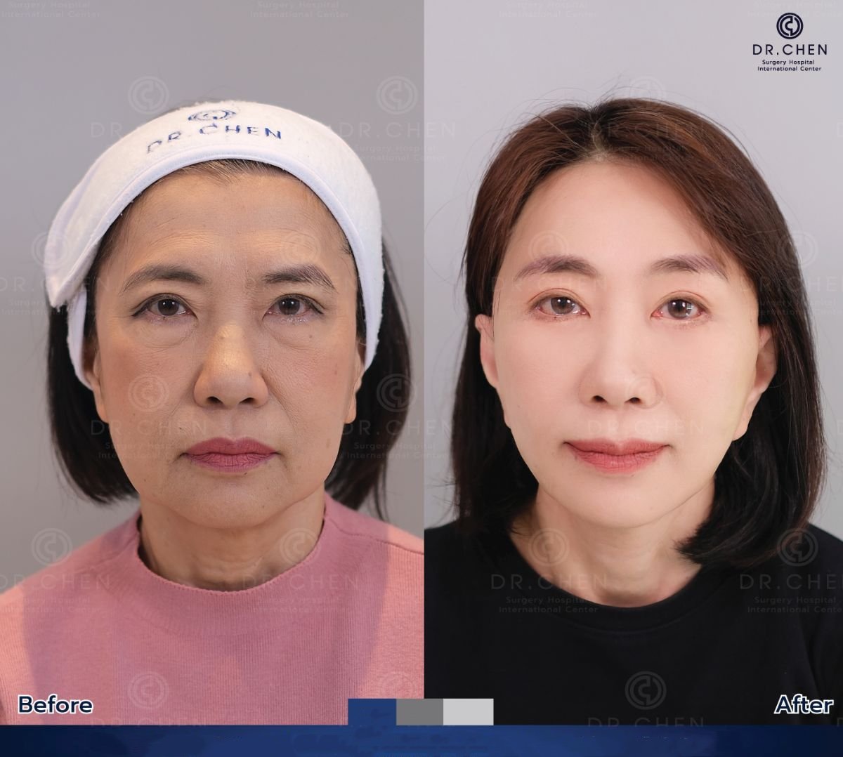 Результаты блефаропластики до и после в Dr. Chen Surgery Hospital International Center
