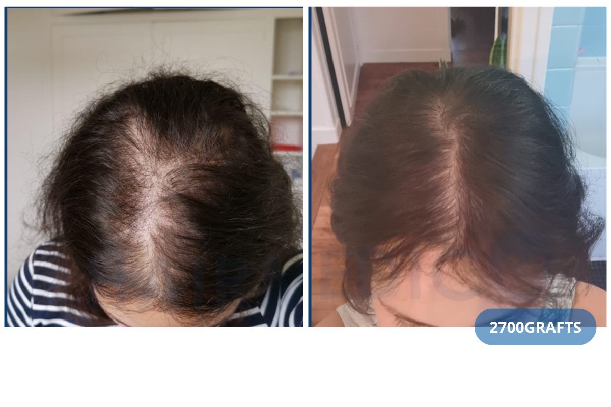 Before and after DHI hair transplant at Hairmedico Clinic, 2700 grafts for fuller hair result