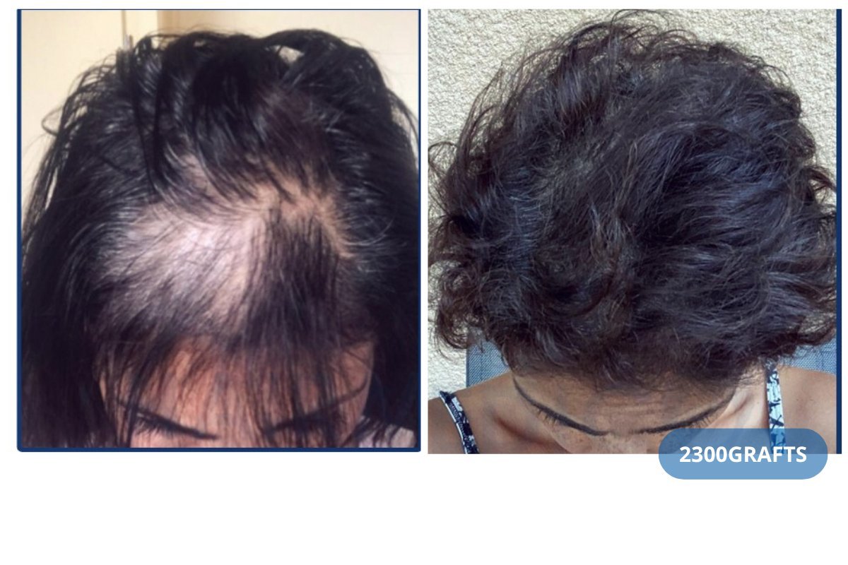 До та після DHI пересадки волосся в клініці Hairmedico, 2300 графтів, помітна густота