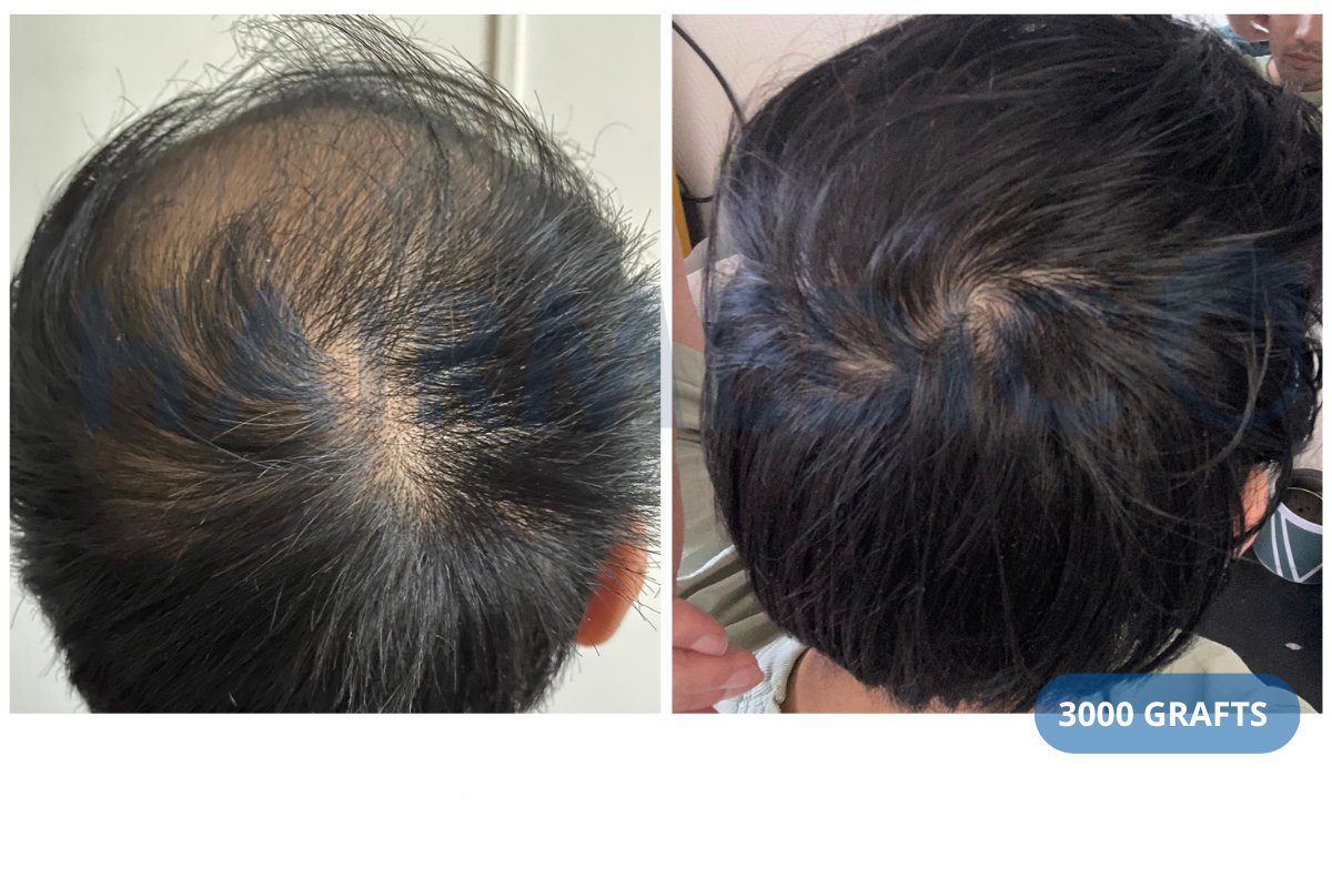 Resultado de trasplante capilar FUE en Hairmedico Clinic antes y después con 3000 injertos