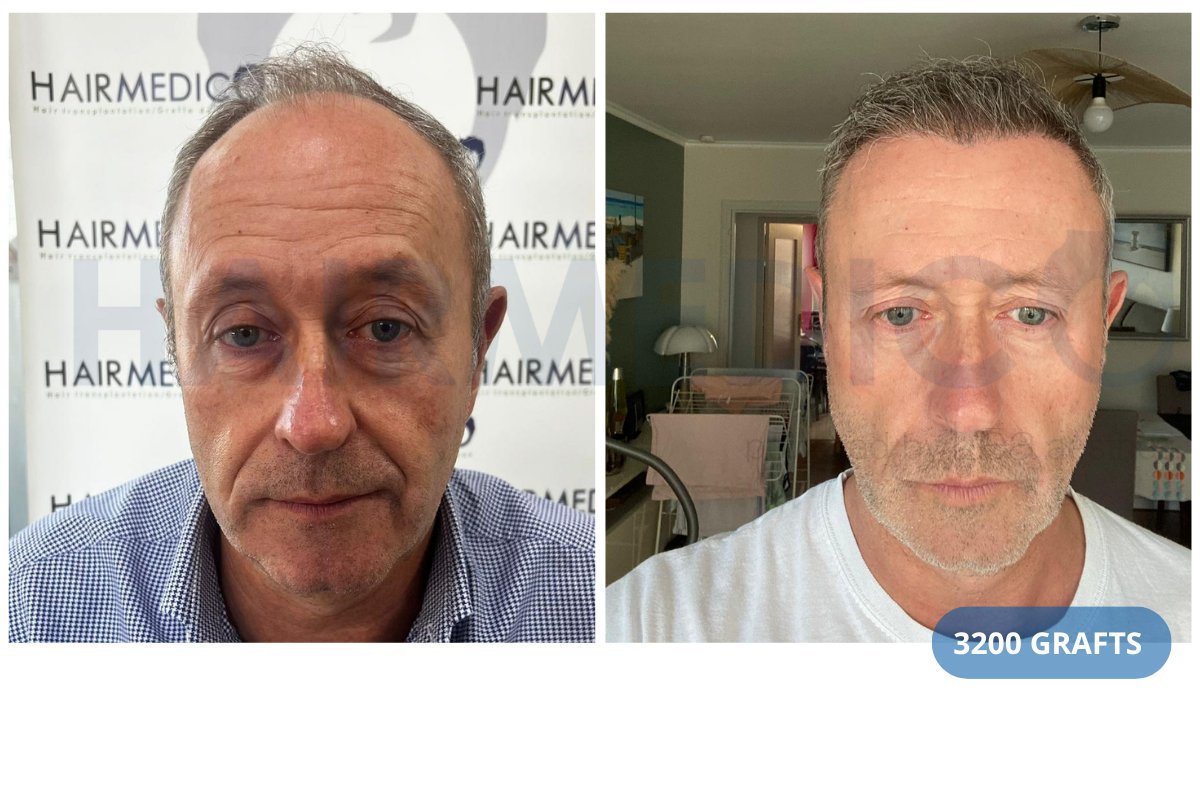 Antes y después de trasplante capilar FUE en Hairmedico Clinic, resultado de 3200 injertos