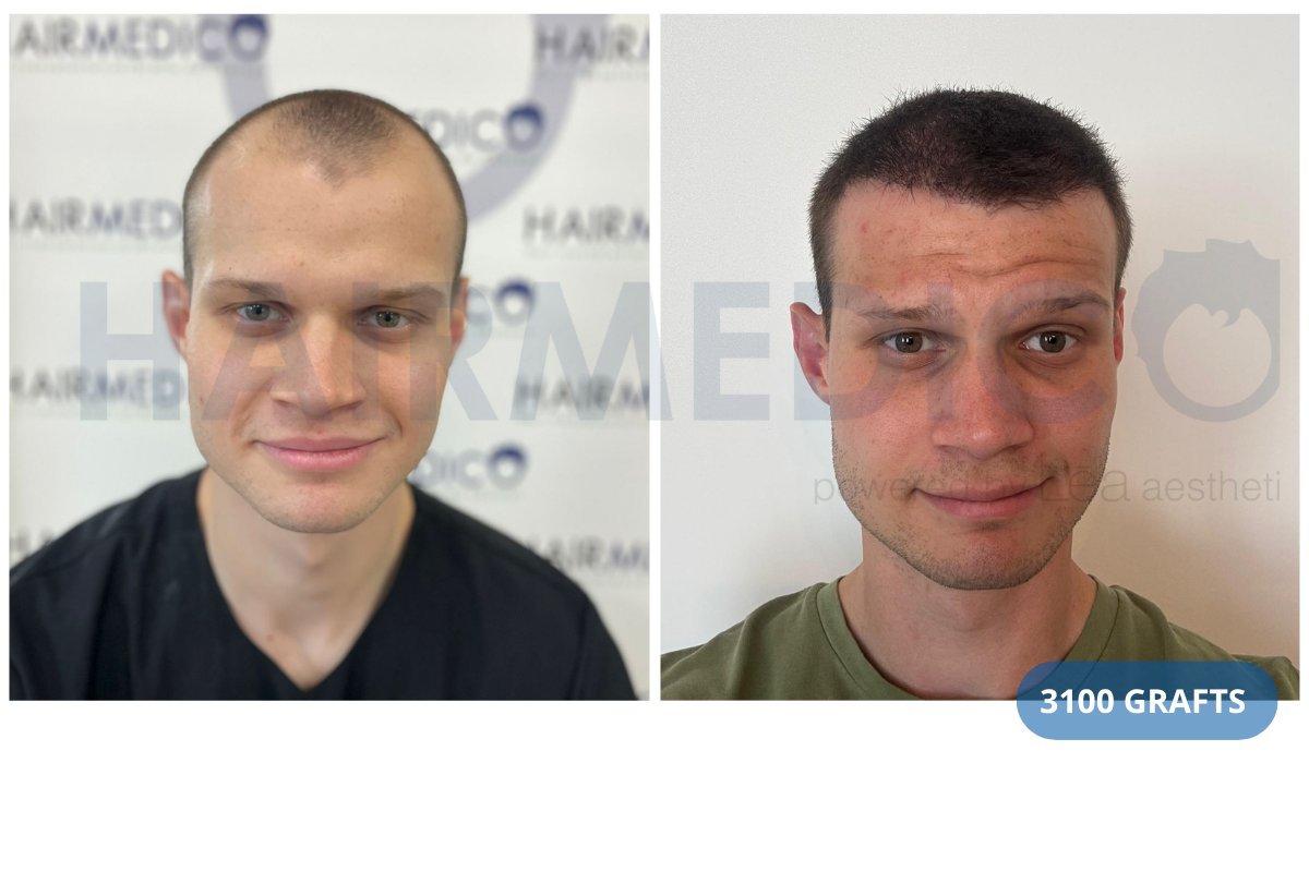 Resultado de trasplante capilar FUE en Hairmedico Clinic, 3100 injertos, línea mejorada