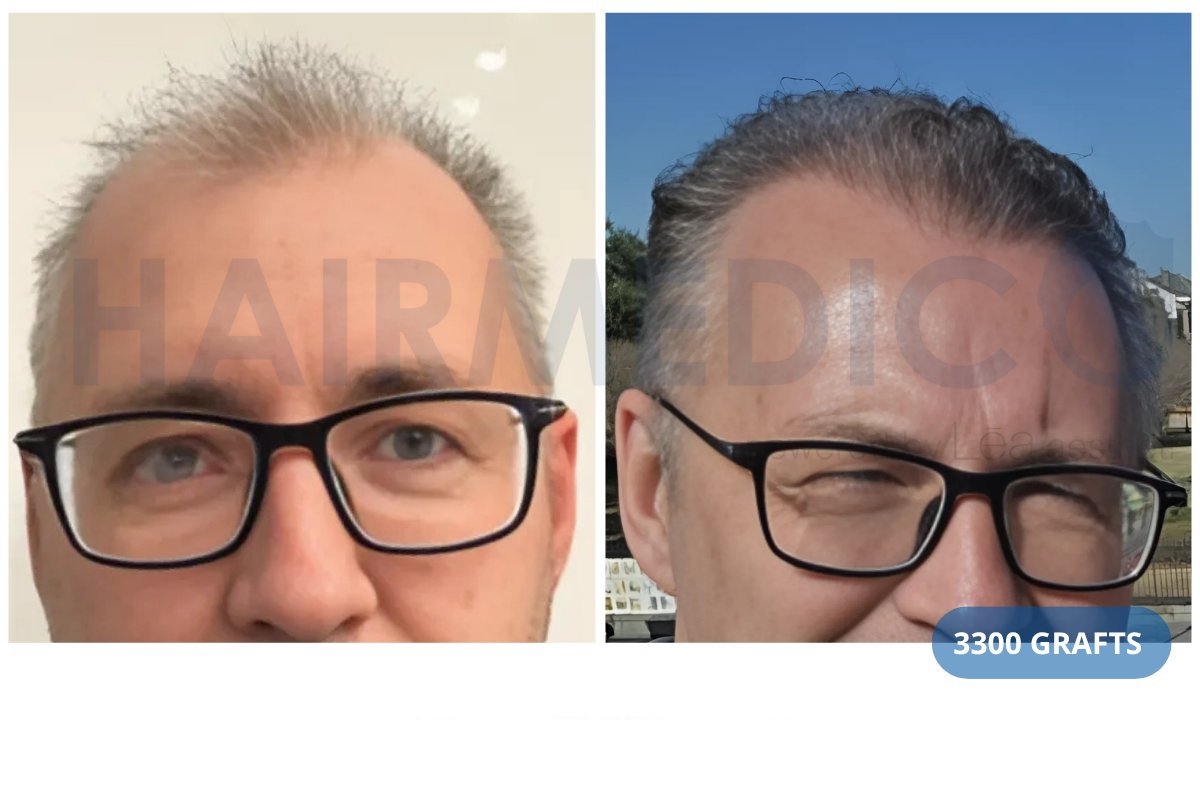 نتائج زراعة الشعر FUE في عيادة Hairmedico قبل وبعد، 3300 طعم لكثافة الشعر