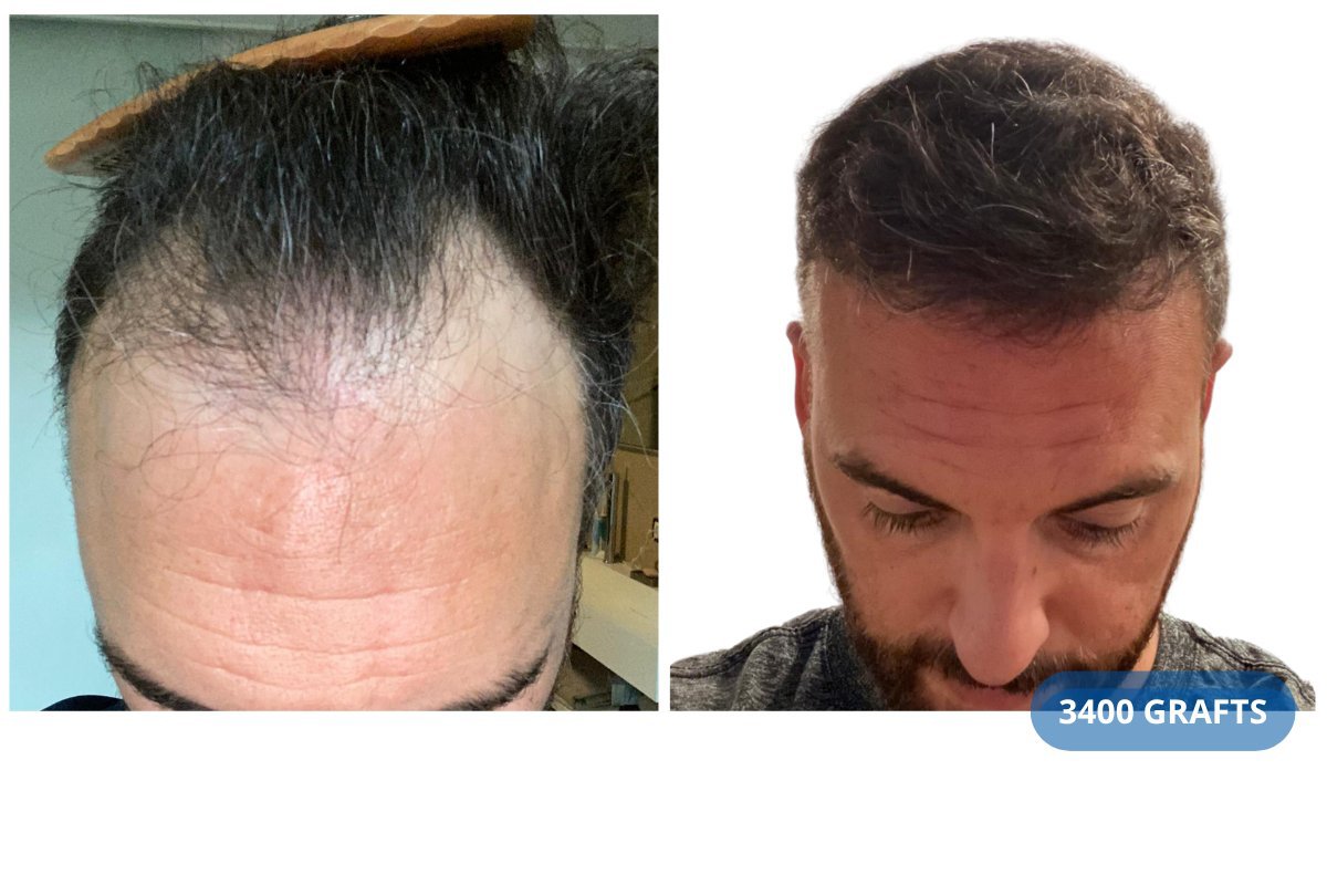 Before and after FUE hair transplant at Hairmedico Clinic, 3400 grafts, visible hairline result